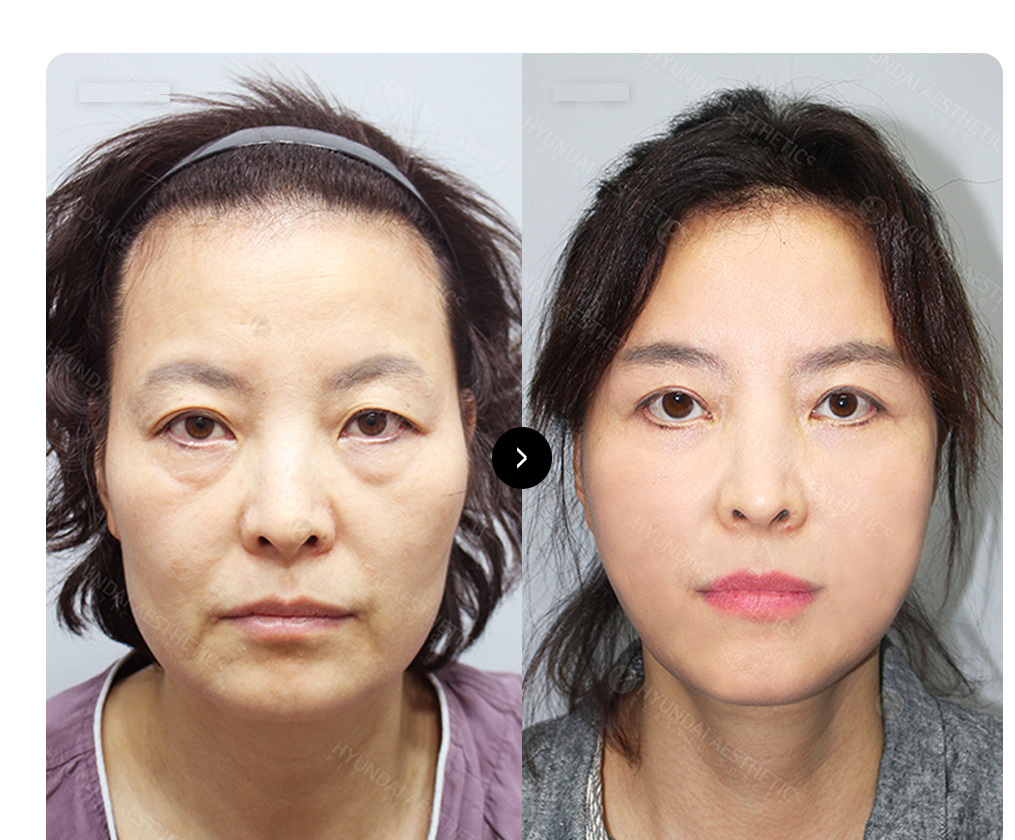 SMAS căng da mặt BEFORE & AFTER — so sánh trước và sau phẫu thuật