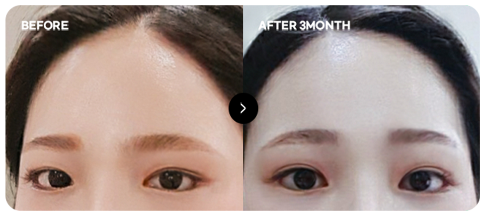 Trước và sau nâng trán trẻ hóa 5