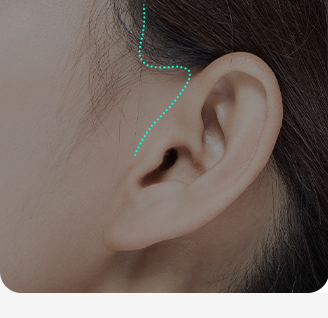 Đường rạch siêu nhỏ trước tai