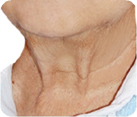 Nếp nhăn cổ dạng gà tây — nếp nhăn cổ kéo dài theo chiều dọc