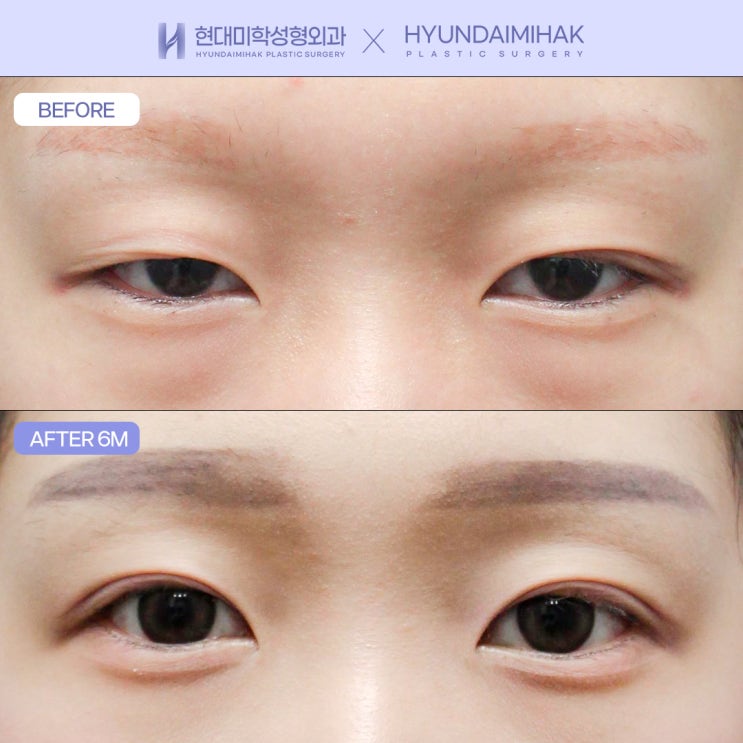 Phẫu thuật chỉnh cơ nâng mi bằng đường rạch giúp mở mắt dễ dàng hơn
