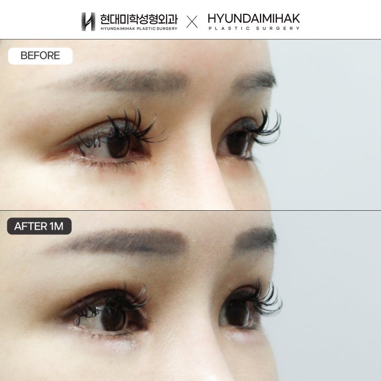 Sự khác biệt về phương pháp trước và sau phẫu thuật chỉnh hình mắt và cách đạt được kết quả mong muốn