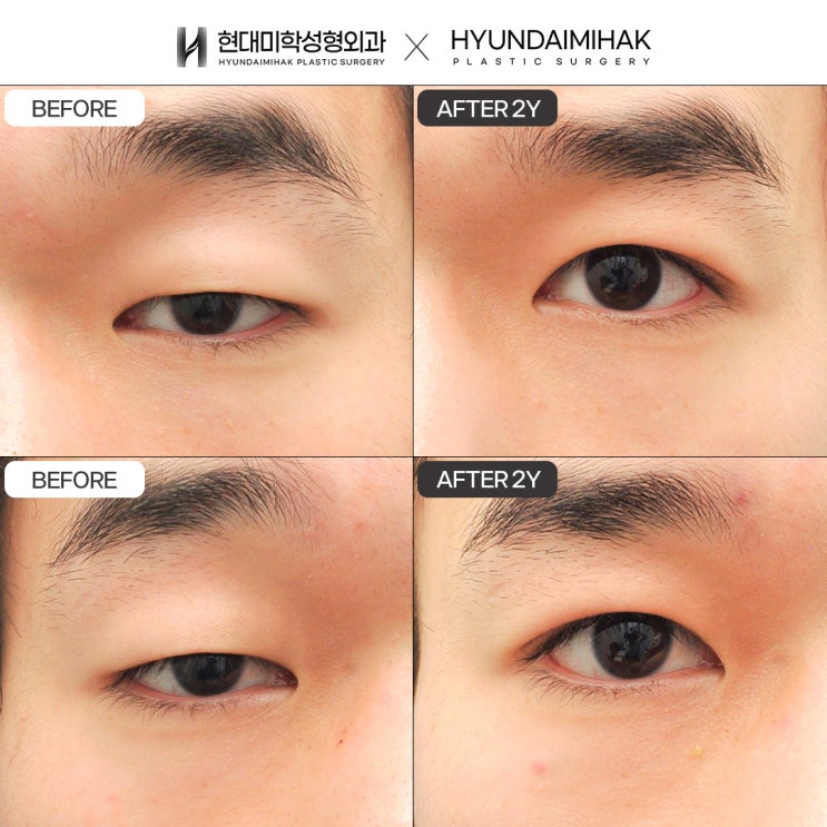 Phẫu thuật mắt nam: phương pháp chắc chắn nhất để tạo ấn tượng đầu tiên rõ nét