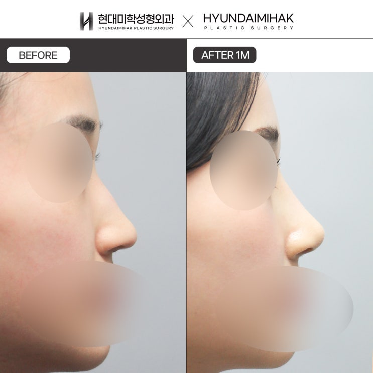 Phẫu thuật chỉnh mũi gồ cần được kiểm tra kỹ lưỡng