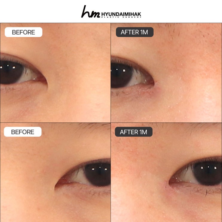Thông tin cốt lõi cần biết để hài lòng cả về chi phí lẫn kết quả tái phẫu thuật mở góc mắt trong
