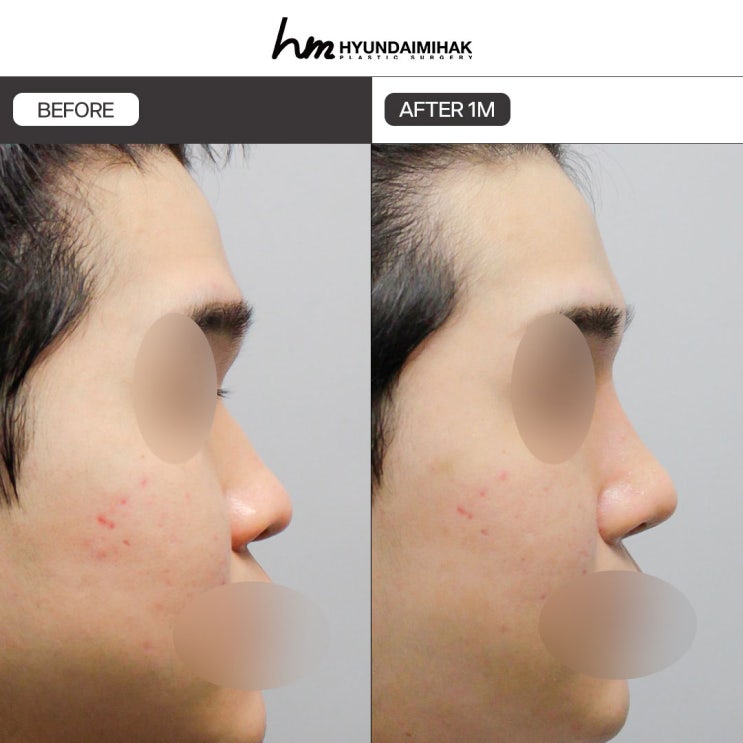Phẫu thuật nâng mũi nam: khởi đầu cho lựa chọn thay đổi ấn tượng đầu tiên