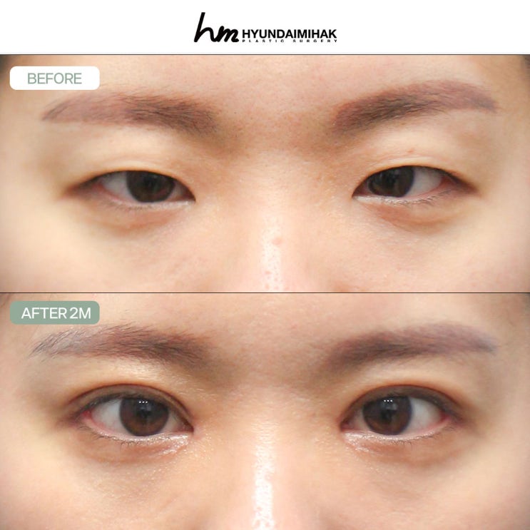 Cách Thẩm mỹ Hyundai tại Gangnam hoàn thiện đôi mắt đẹp mà không lo phải phẫu thuật lại