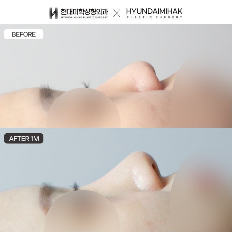 Những điều quan trọng cần cân nhắc khi chọn nơi nâng mũi uy tín