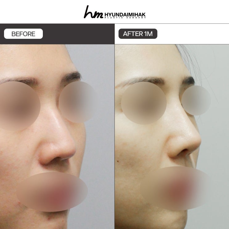 Những điều cần biết trước khi tư vấn phẫu thuật nâng mũi