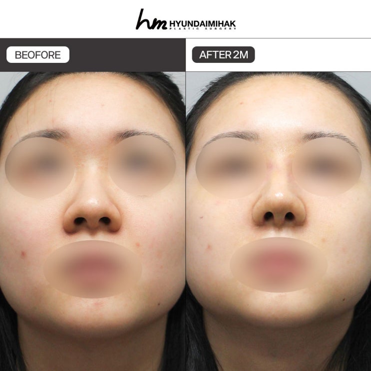 Trước và sau phẫu thuật mũi củ tỏi: bí quyết thay đổi diện mạo tự nhiên, thanh tú | Kinh nghiệm chỉnh mũi củ tỏi của Thẩm mỹ Hyundai