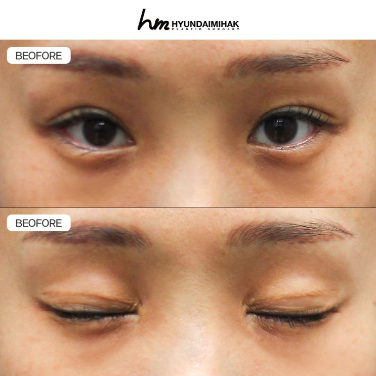 Tái phẫu thuật mắt: thay đổi ngay từ bước chọn đường mí đôi