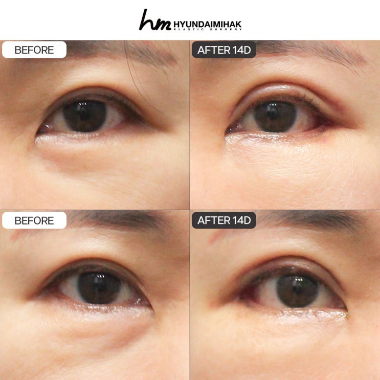 Lựa chọn bệnh viện là yếu tố then chốt khi tái phẫu thuật dual canthoplasty