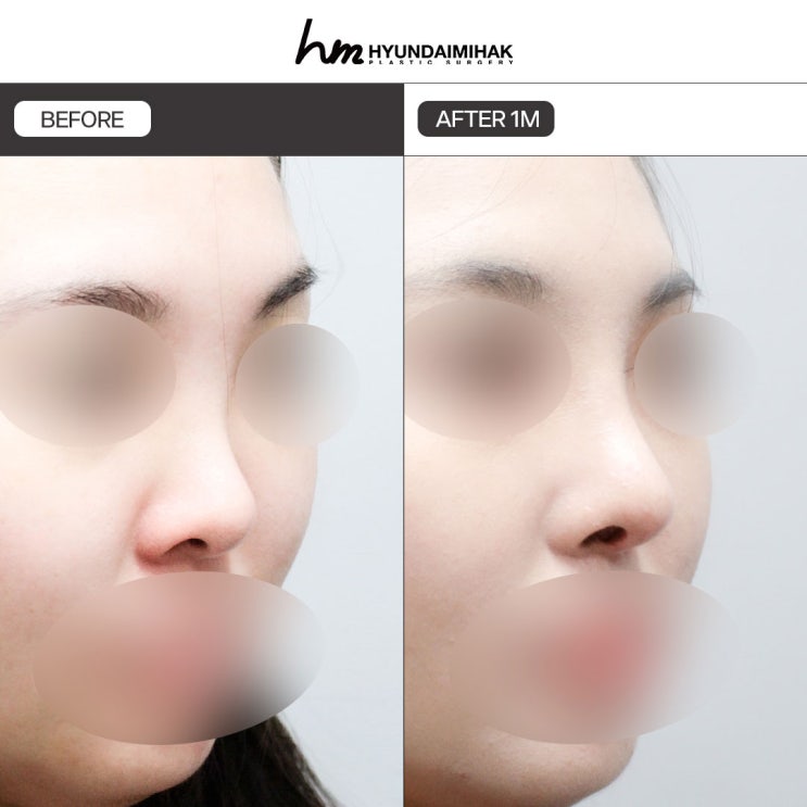 Bí quyết chỉnh sửa giúp thay đổi ấn tượng trong phẫu thuật mũi ngắn