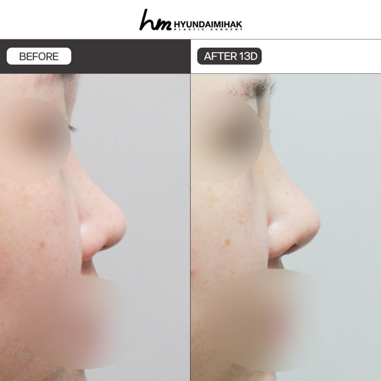 Phẫu thuật chỉnh mũi ngắn, hoàn thiện đường nghiêng thanh thoát
