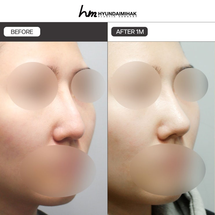 Phẫu thuật góc mũi môi: chìa khóa cải thiện gương mặt cân đối