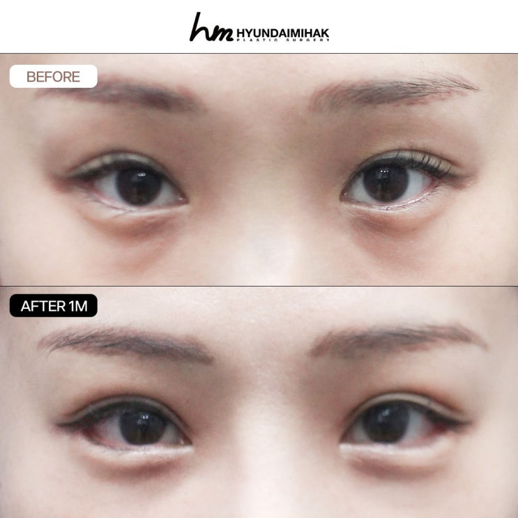 Nếu bạn muốn thay đổi ấn tượng gượng gạo một cách tự nhiên tại bệnh viện tái phẫu thuật mũi