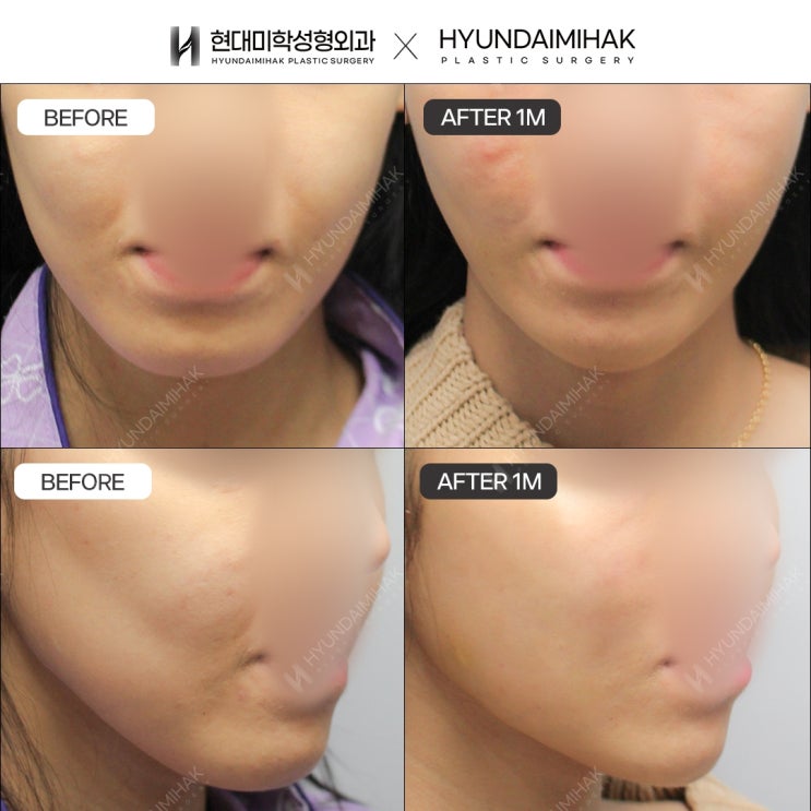 Bệnh viện căng chỉ: thay đổi làn da nhanh chóng và hiệu quả