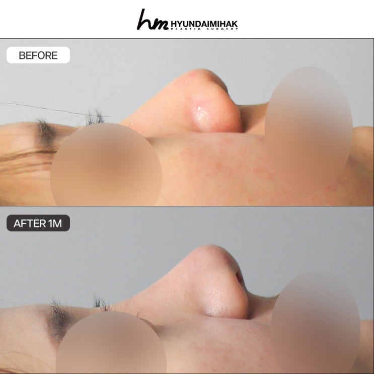 Việc lựa chọn bệnh viện nâng mũi có thể thay đổi hoàn toàn hình ảnh khuôn mặt