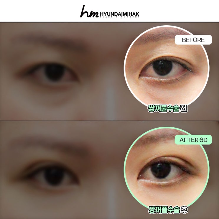 Hướng dẫn lựa chọn phẫu thuật mắt tại Gangnam, từ lần đầu đến phẫu thuật chỉnh sửa