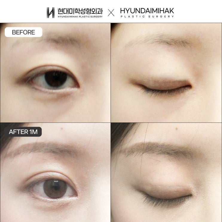 Khôi phục dáng mắt tự nhiên bằng lựa chọn thận trọng với phẫu thuật sửa mí đôi bằng phương pháp rạch