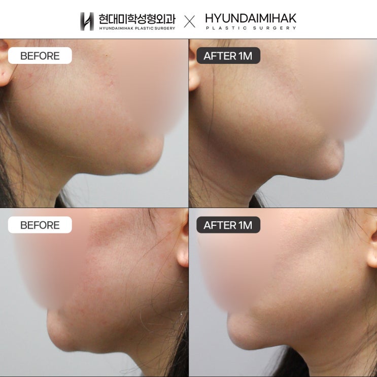 Giải quyết nỗi lo nọng cằm bằng phương pháp nâng nọng cằm như thế nào