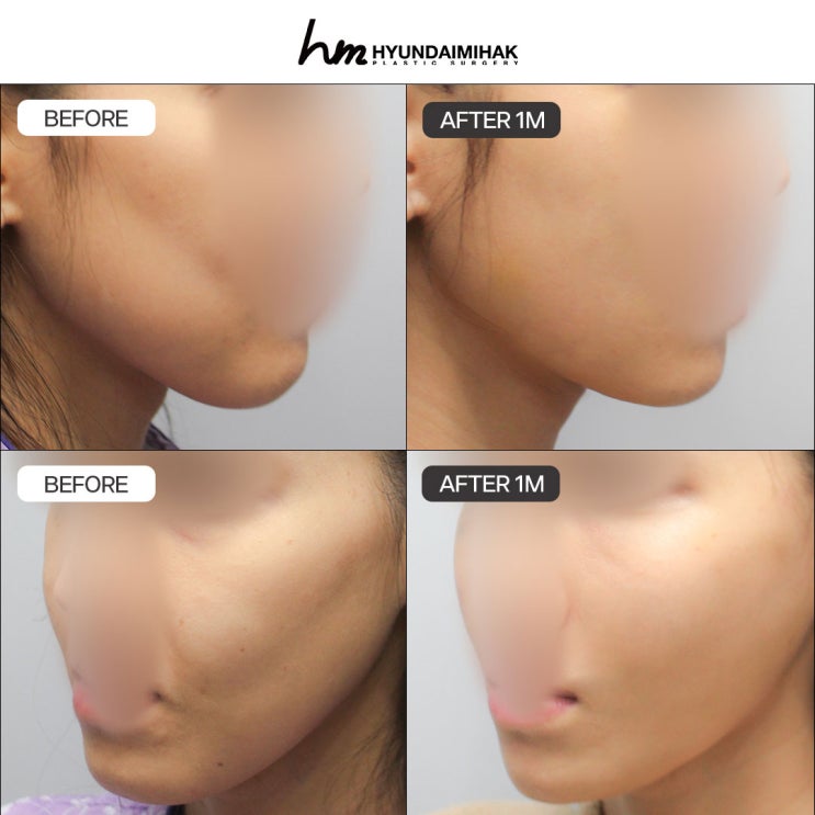 Giá nâng cơ mặt: nhất định cần kiểm tra những tiêu chí này