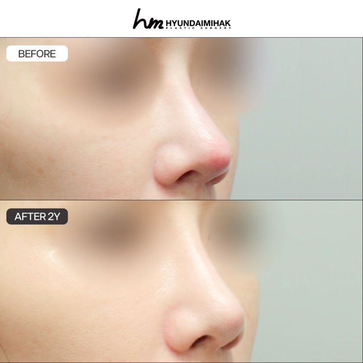 Lộ sụn silicone mũi: điều kiện để có dáng mũi an toàn và đẹp