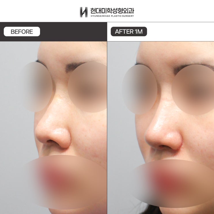 Những ưu điểm của sụn sườn hiến tặng được nhắc đến trong các review nâng mũi bằng sụn sườn hiến tặng