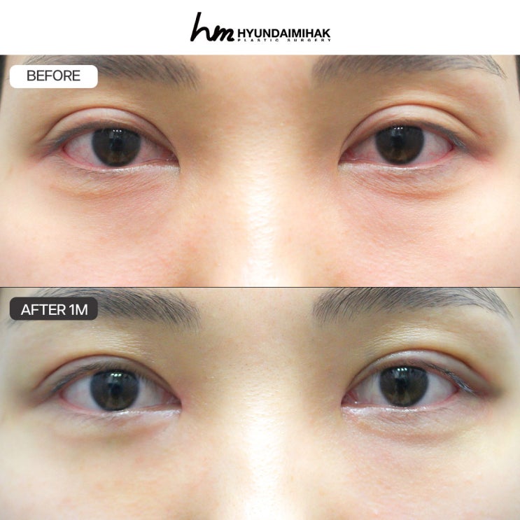 Chọn bệnh viện tái phẫu thuật mí mắt để không phải hối tiếc lần nữa