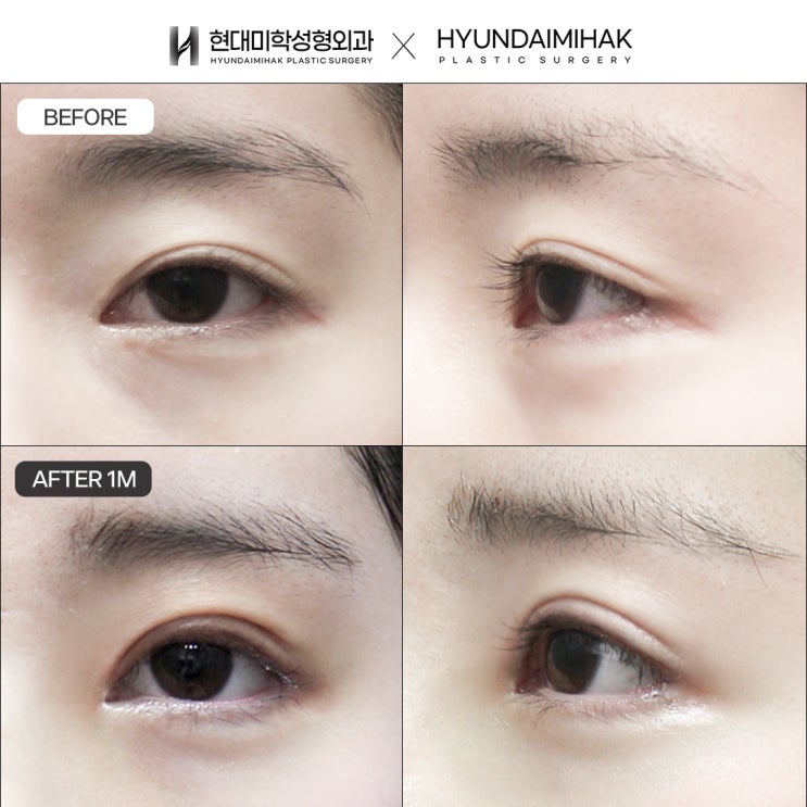 Giảm nếp rẻ quạt và tạo đôi mắt thoáng rộng hơn bằng phẫu thuật mở rộng mắt toàn diện