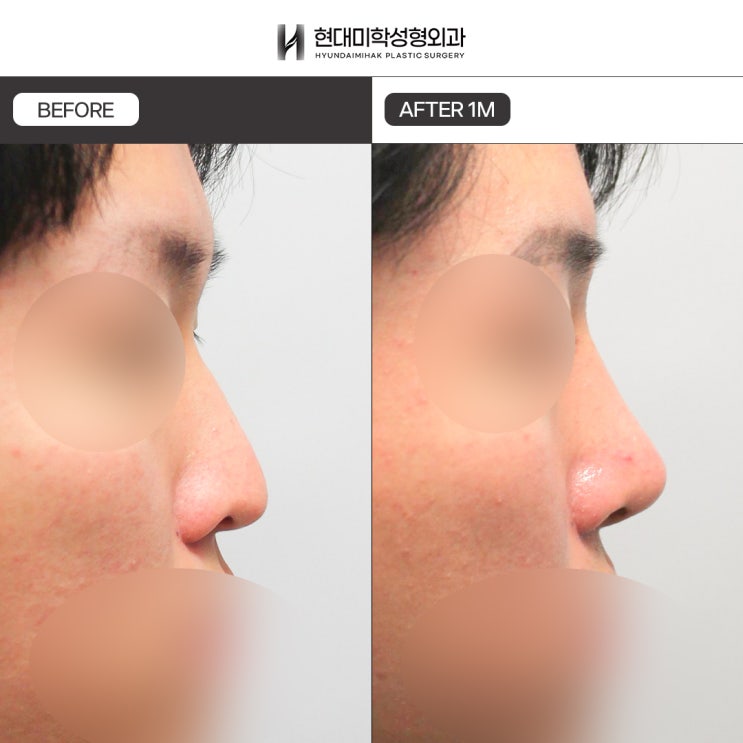 Ví dụ phân tích so sánh trước và sau nâng mũi nam