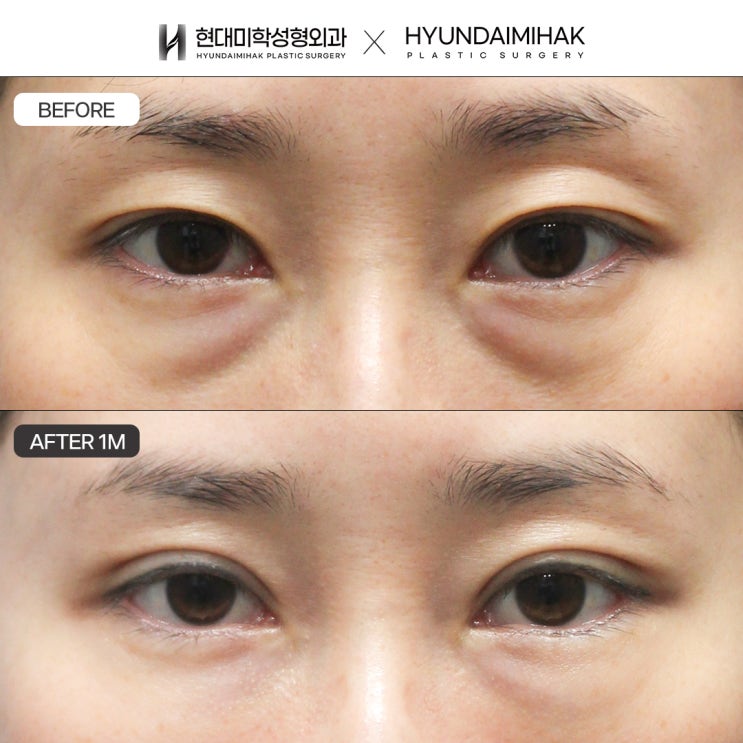 Khắc phục sụp mí tại nơi thực hiện cắt mí trên uy tín, đồng thời cải thiện tầm nhìn