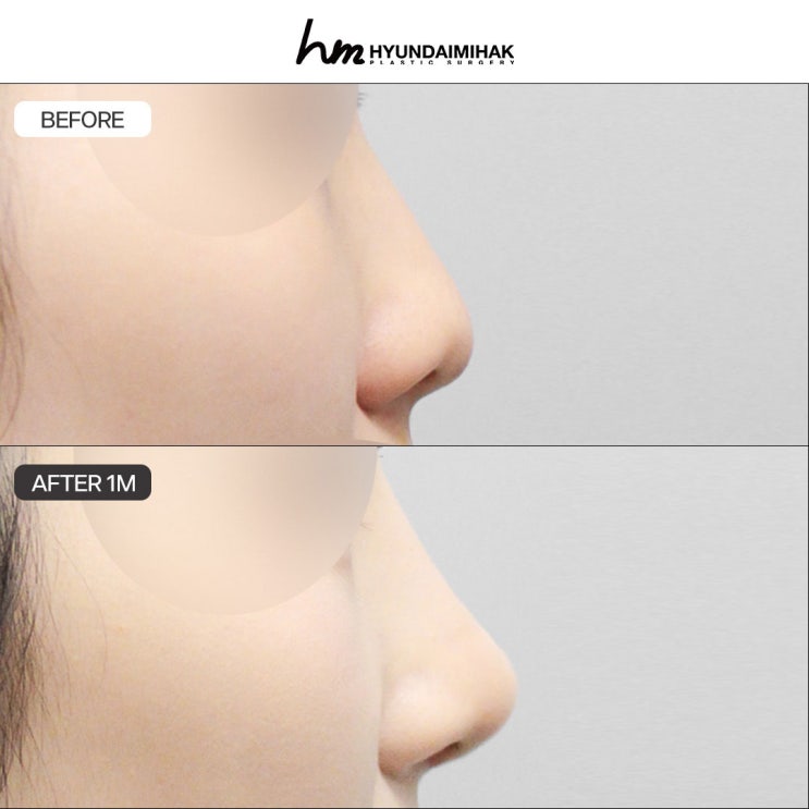 Những điểm cần biết trước và sau phẫu thuật mũi