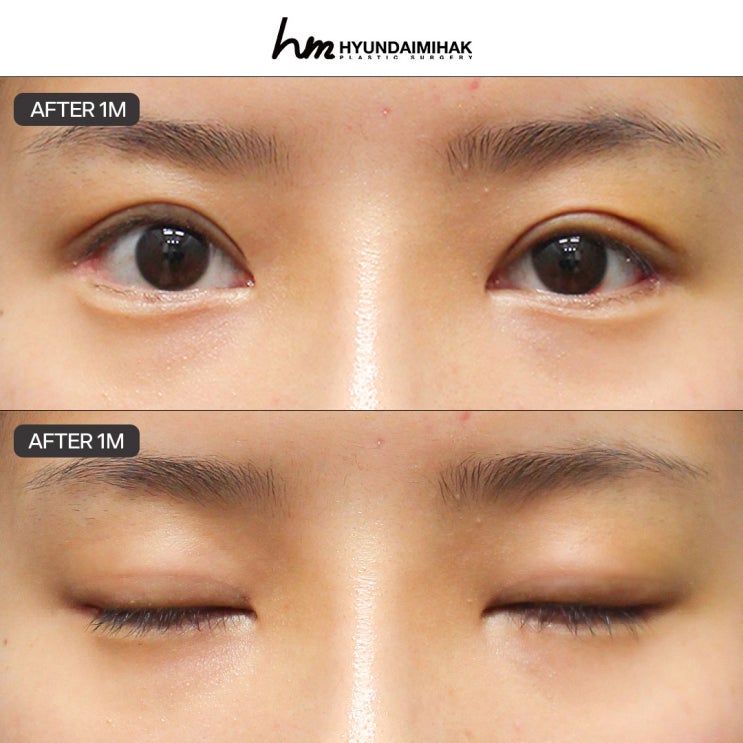 Phẫu thuật cắt mí đôi tại Seoul, khởi đầu cho sự thay đổi ấn tượng