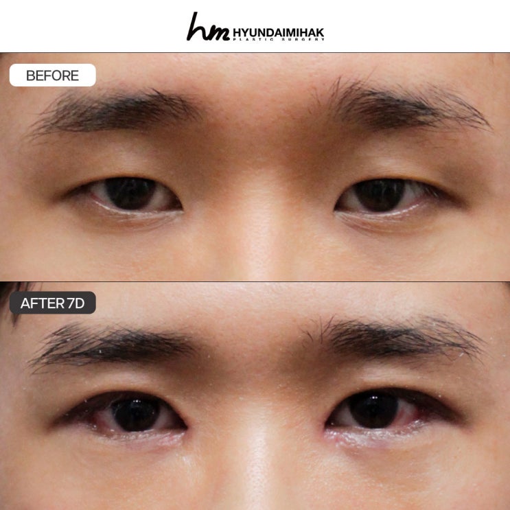 Phẫu thuật mắt nam giới: sự tự nhiên là yếu tố cốt lõi