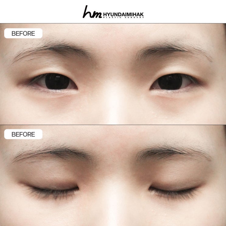 Phẫu thuật cắt mí đôi: tạo hình thiết kế thay đổi bản chất đôi mắt|Tổng hợp đầy đủ phương pháp phẫu thuật, mức độ hài lòng và cách hồi phục