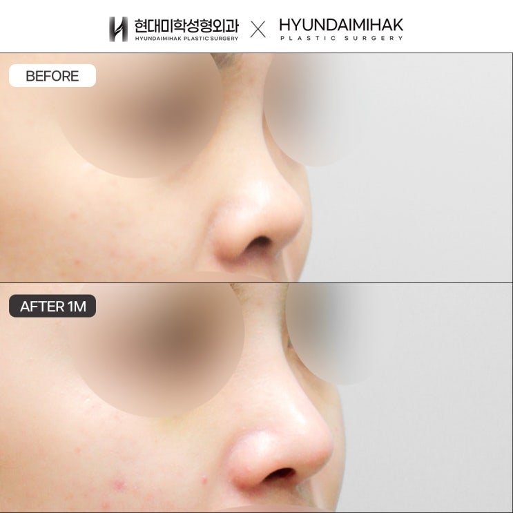 Tái phẫu thuật mũi bằng sụn sườn hiến tặng, đâu là lựa chọn phù hợp với tôi