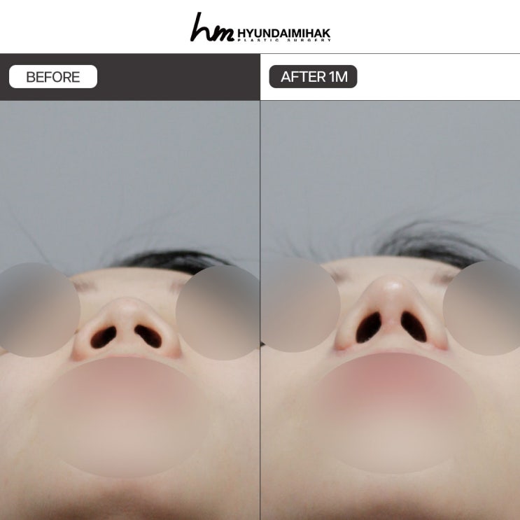 Phẫu thuật chỉnh mũi hếch: Giải pháp cốt lõi giúp thay đổi ấn tượng khuôn mặt