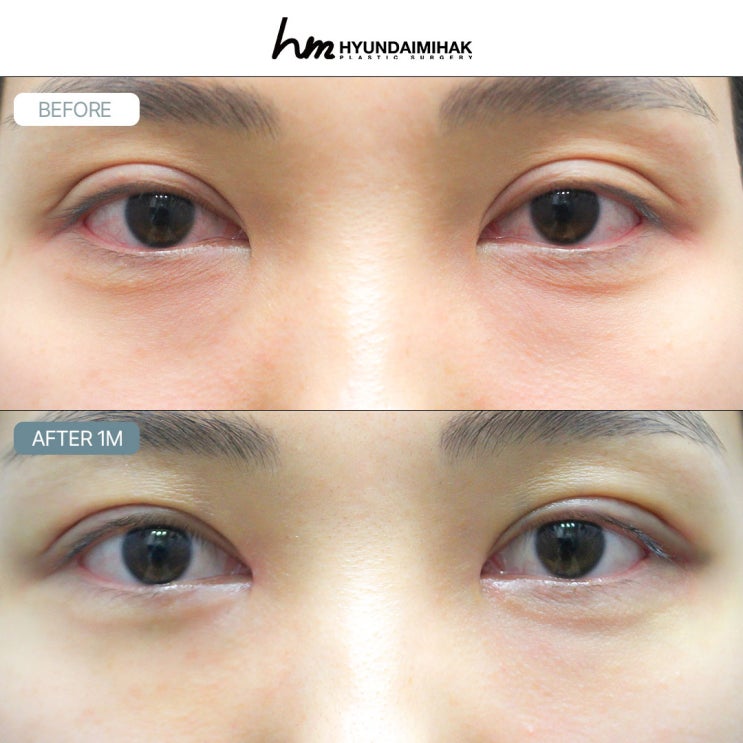 Tổng hợp đánh giá phẫu thuật chỉnh sửa mắt: Những điểm mấu chốt để thành công từ Thẩm mỹ Hyundai