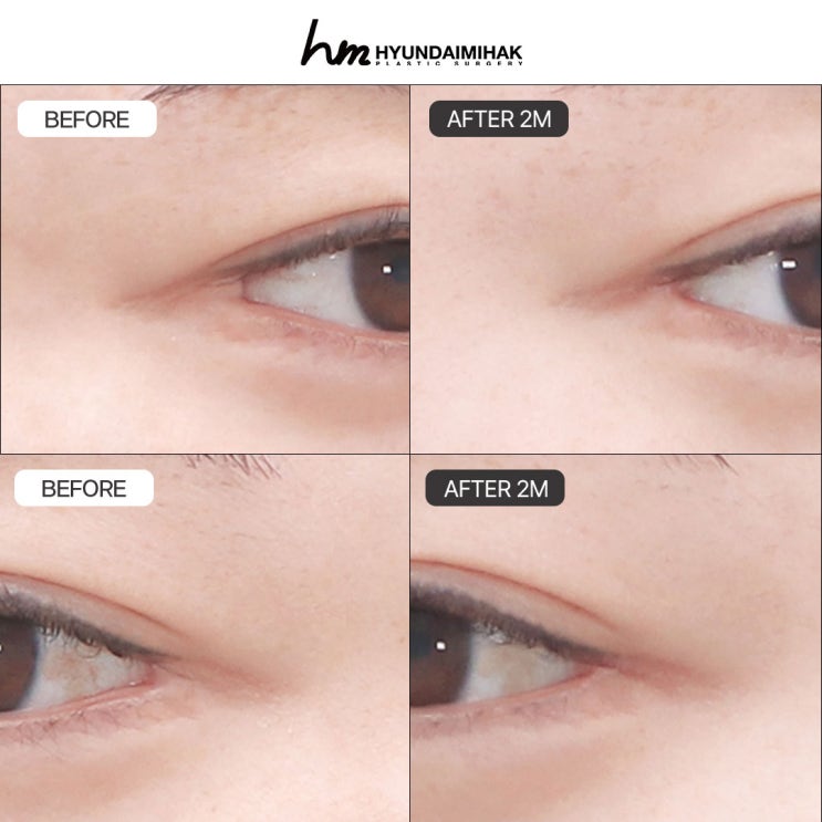Phục hồi mở rộng đuôi mắt: giải pháp cá nhân hóa cho đôi mắt như được tái sinh