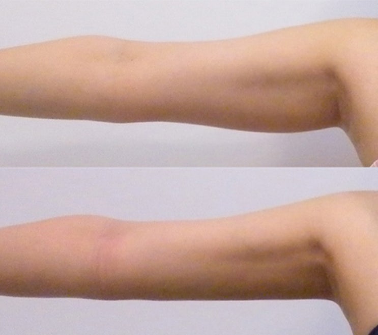 Mỡ bắp tay chảy xệ: đâu là giải pháp phù hợp với tôi?