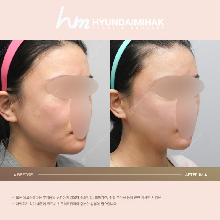 Gợi ý tiêm tạo đường nét: nếu bạn muốn giảm mỡ mặt và tìm lại V-line