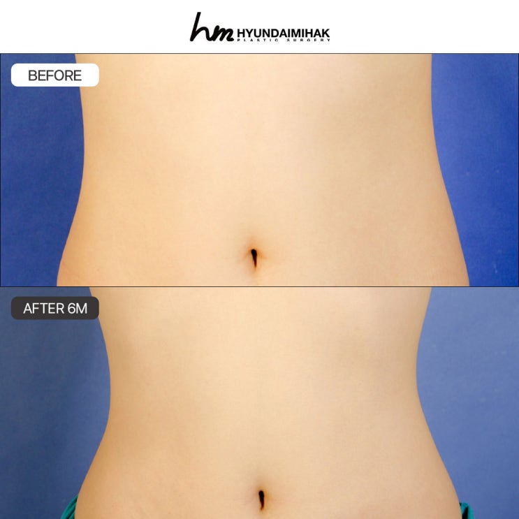Bí quyết sở hữu vòng bụng săn chắc với liệu trình điều trị cellulite chỉ trong một lần