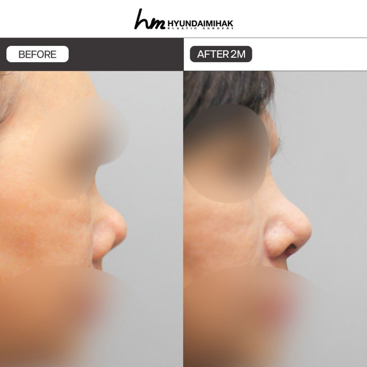 Vì sao cần phẫu thuật mũi co rút và nên chuẩn bị như thế nào