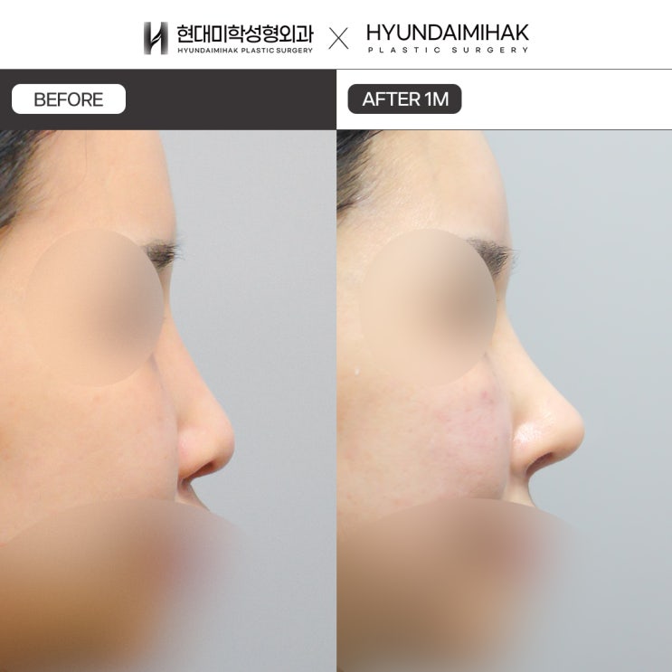 Tìm hiểu ưu điểm và đặc điểm của nâng mũi bằng sụn sườn tự thân