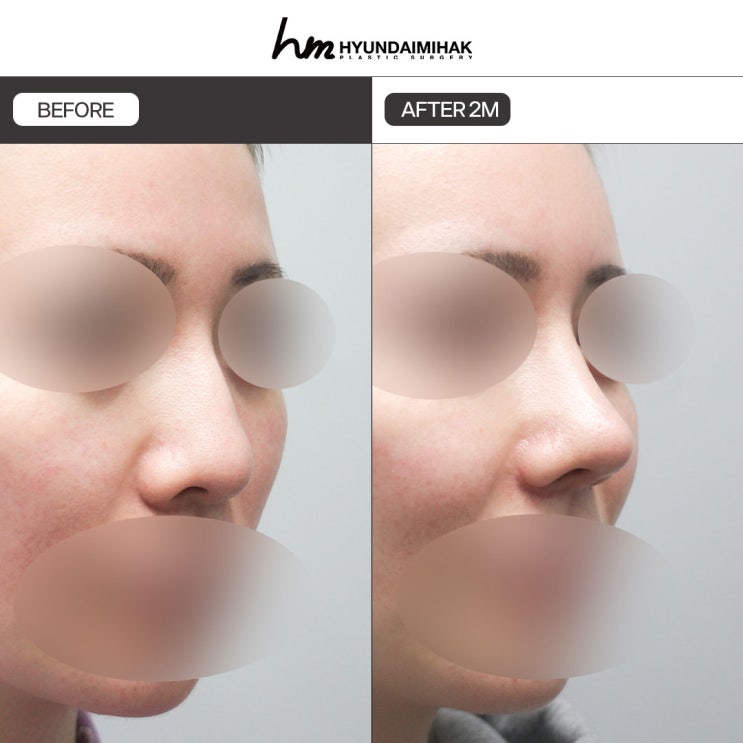 Phẫu thuật nâng mũi thấp nếu làm sai có thể khiến kết quả tệ hơn