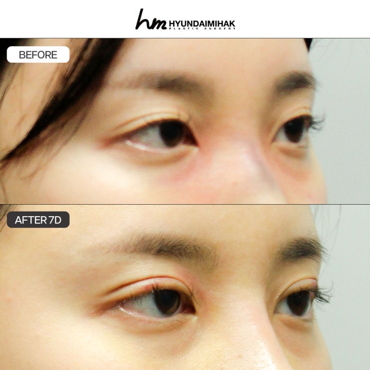 Lý do Thẩm mỹ Hyundai là lựa chọn đúng đắn khi chọn bệnh viện thẩm mỹ mắt ở Gangnam