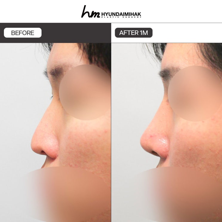 Bí mật đằng sau diện mạo thay đổi sau nâng mũi nam