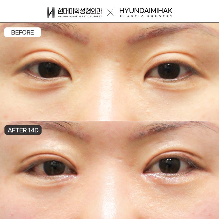 Hạ thấp nếp mí đôi để cải thiện dáng mắt trông thiếu tự nhiên
