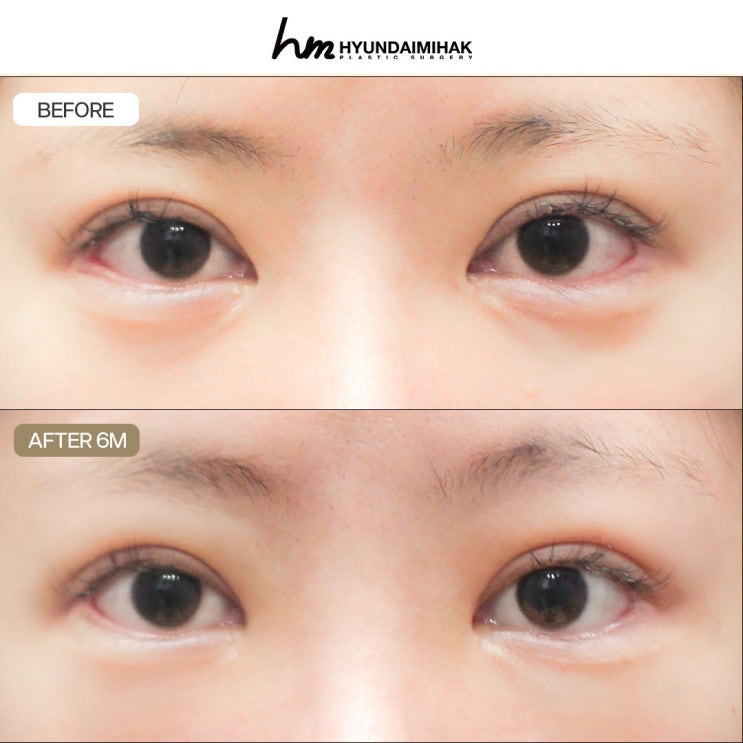 Tái tạo khóe mắt trong: Làm sao để khắc phục phẫu thuật mở khóe mắt trong bị hỏng